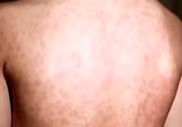 Mohave County's Measles Outbreak Cases Surge