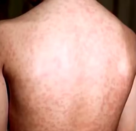Mohave County's Measles Outbreak Cases Surge